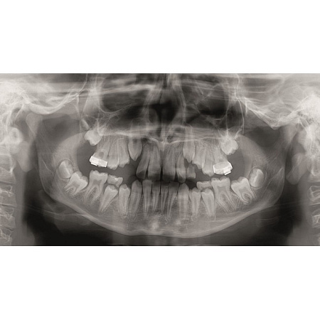 KaVo Pan eXam Plus 3D Ceph - универсальный датчик Pan/Ceph для панорамной томографии, цефалостат, функция 3D-томографии 6x8 см